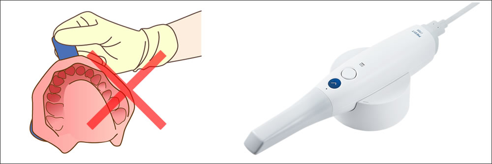 口腔内スキャナーを駆使した精密な型取り