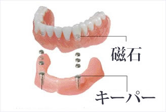 磁性アタッチメント義歯加工